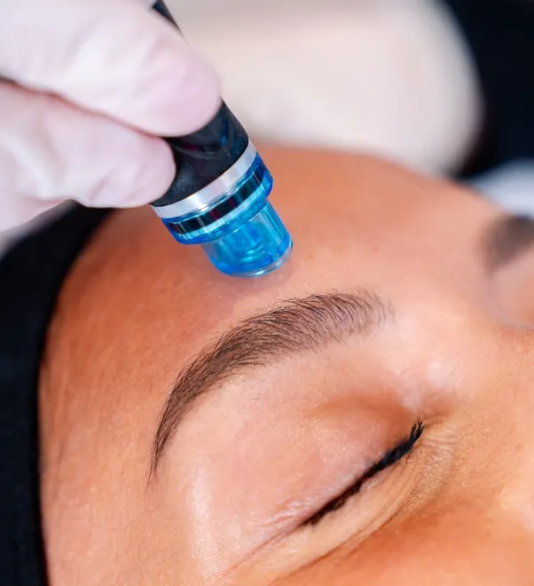The hydrodermabrasion tip on the forehead: it exfoliates, vacuums the pore and infuses serums in one pass